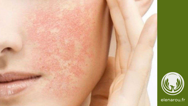 Réaction allergique aux joues